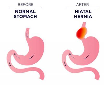 Αντιμετώπιση της διαφραγματοκήλης με ρομποτική χειρουργική