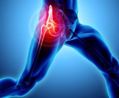 Πόνος στο ισχίο: Ένα συχνό, σύνηθες αλλά και ύπουλο σύμπτωμα