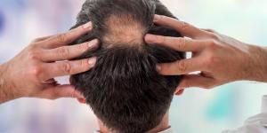 Τριχόπτωση: Μήπως ευθύνονται οι ορμόνες σας;