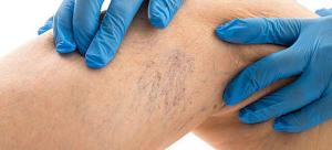 Χρήσιμες απαντήσεις για τους κιρσούς και τη θεραπεία τους