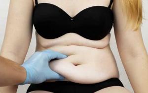 Κοιλιοπλαστική: Πώς βελτιώνει την ποιότητα ζωής;